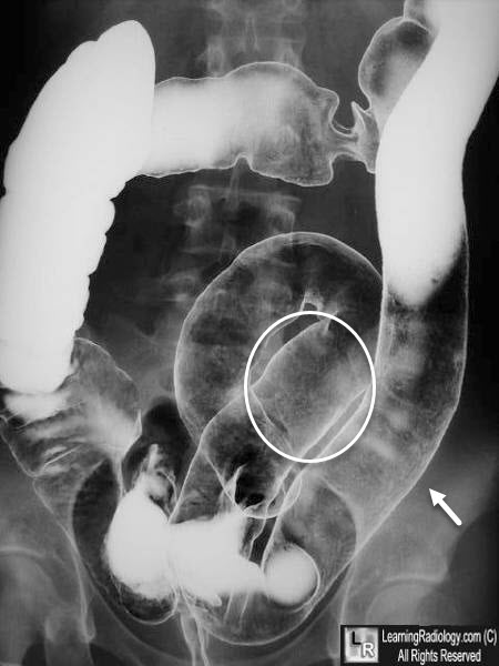 Ulcerative Colitis